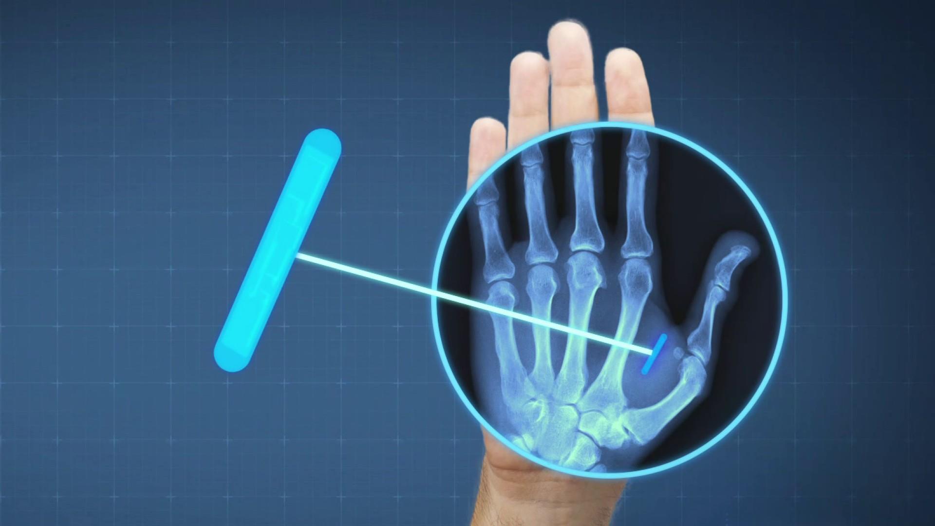 Mikrochip implanteret i hånden? Er det noget at bekymre sig om
